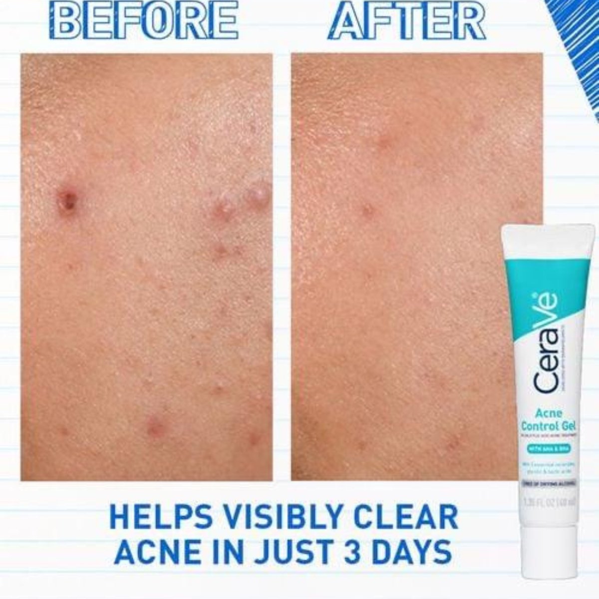 Cerave Acne Control Gel - Bloom Shine